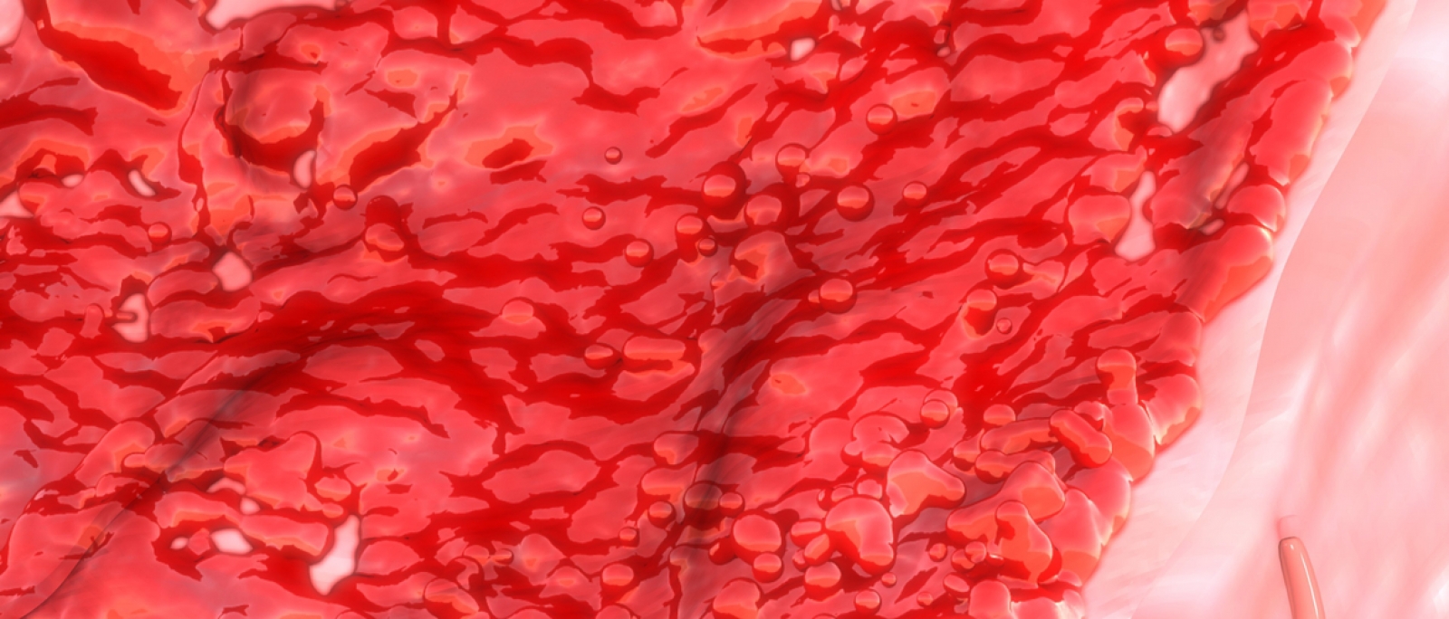 Foto de Sintoma De Endometriose Sangue Menstrual Com Coágulos De